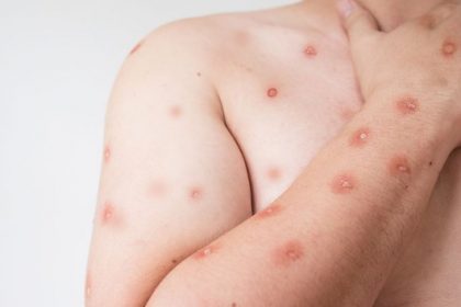 SEMSA MANAUS Informativo Mpox 1