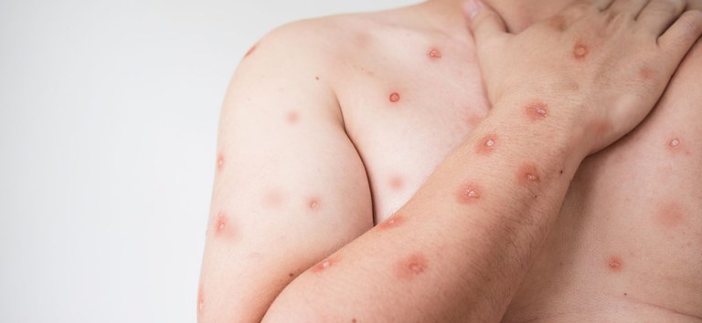 SEMSA MANAUS Informativo Mpox 1